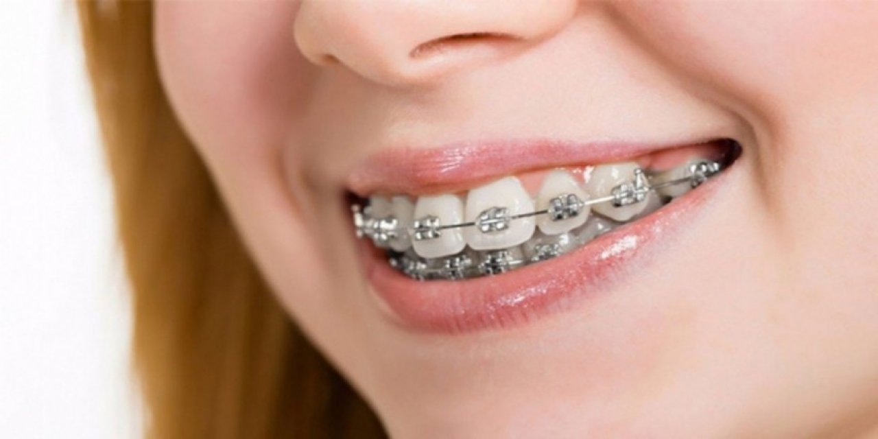 Diş teli tedavisinde hijyen çok önemli