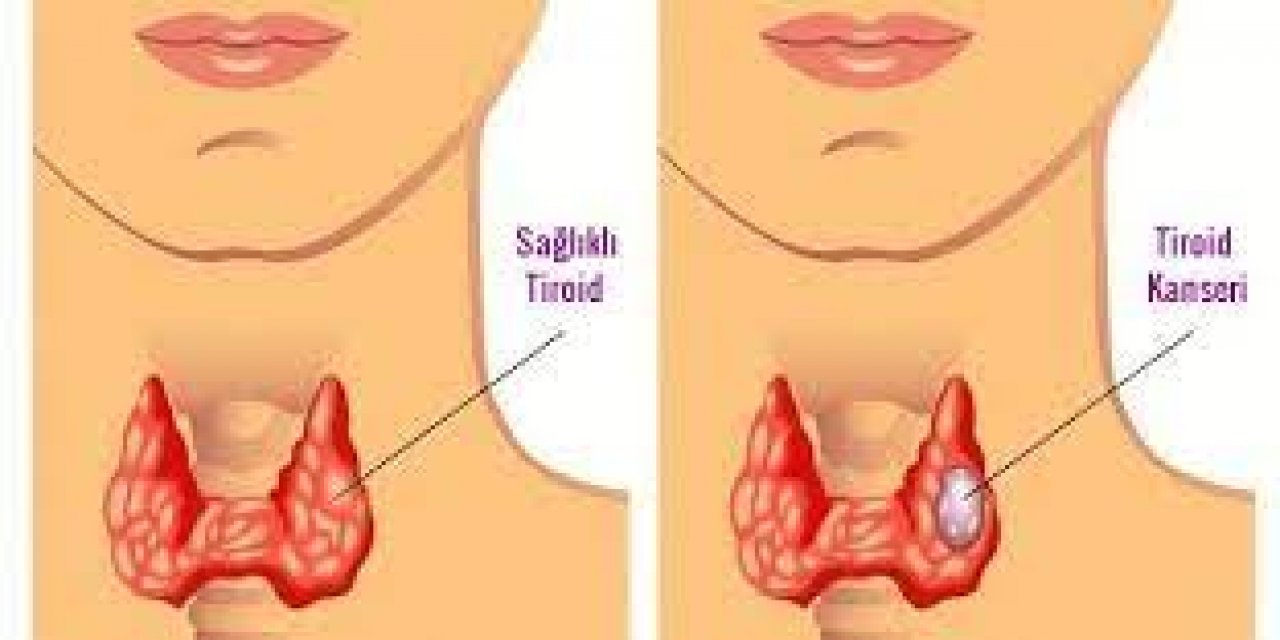 Tiroid kanserleri kadınlarda 3 kat fazla görülüyor