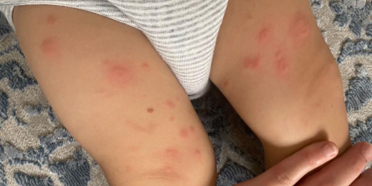 Çocuklarda besin alerjilerine dikkat