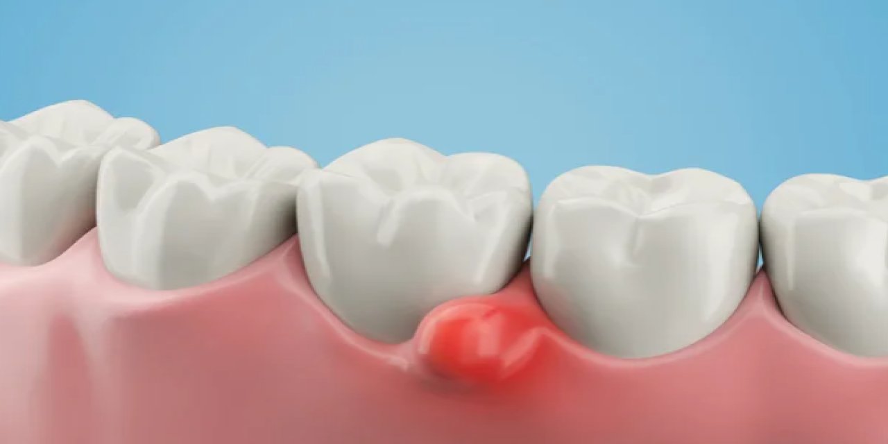Diş Kisti Nedir? Belirtileri ve Tedavisi