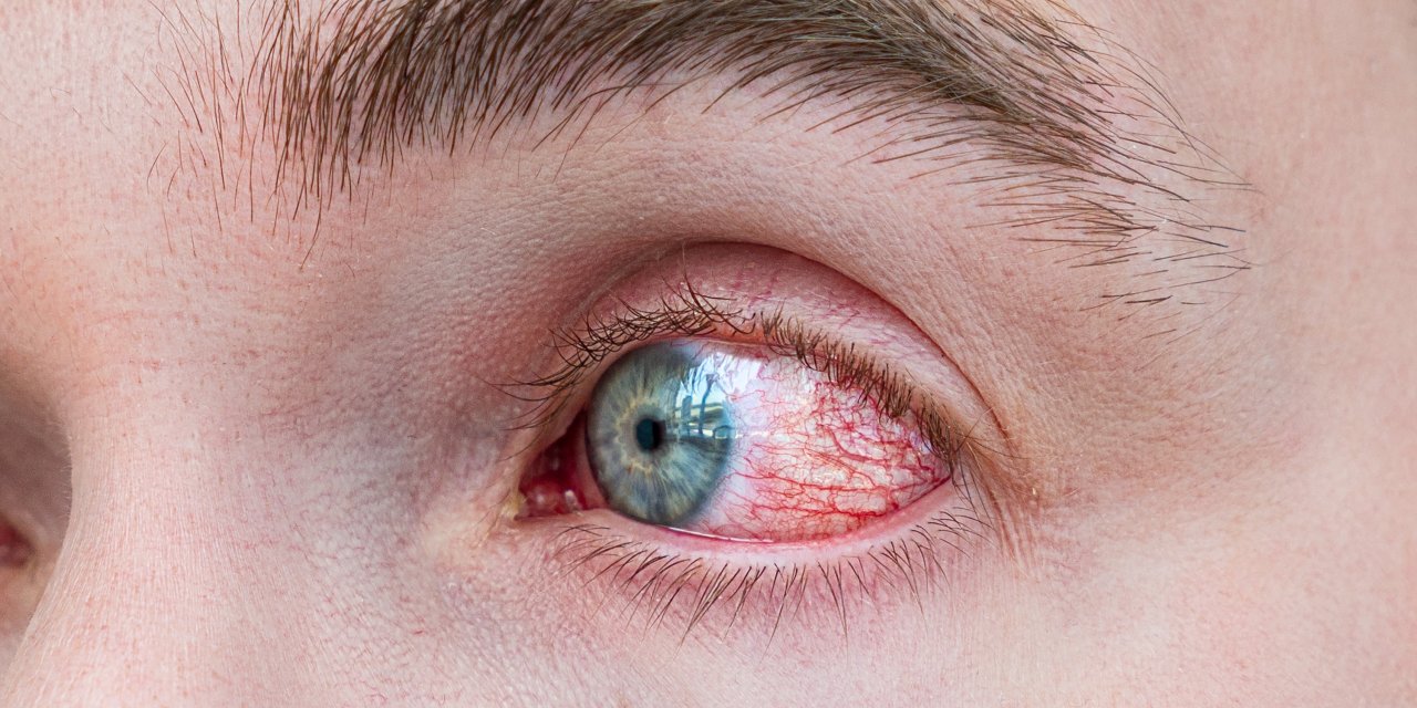 Göz Alerjisi Görme Kaybına Sebep Olabilir