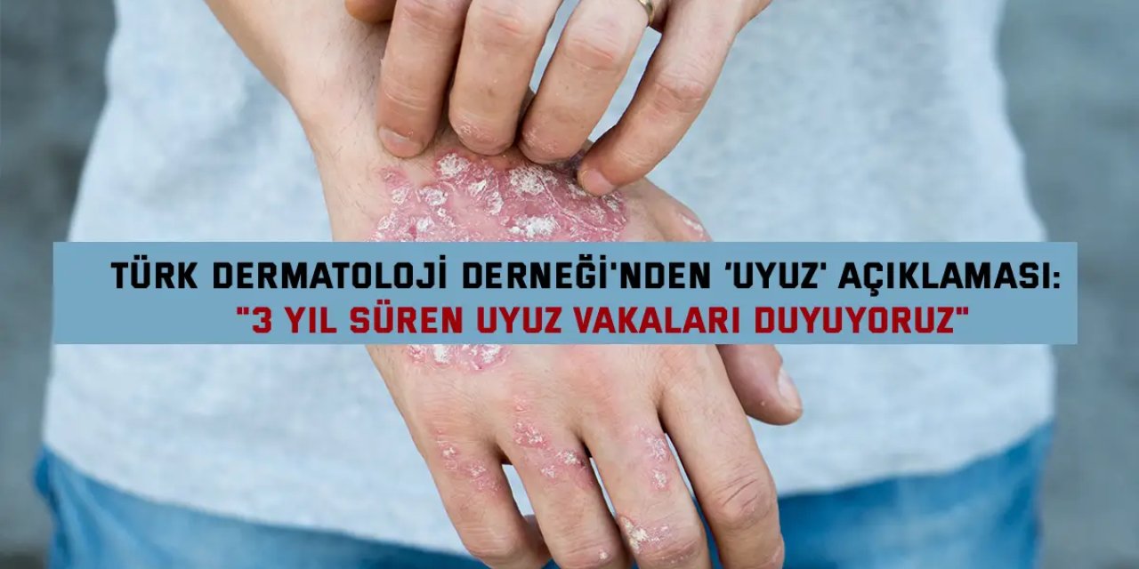 TÜRK DERMATOLOJİ DERNEĞİ'NDEN ‘UYUZ' AÇIKLAMASI:    "3 yıl süren uyuz vakaları duyuyoruz"