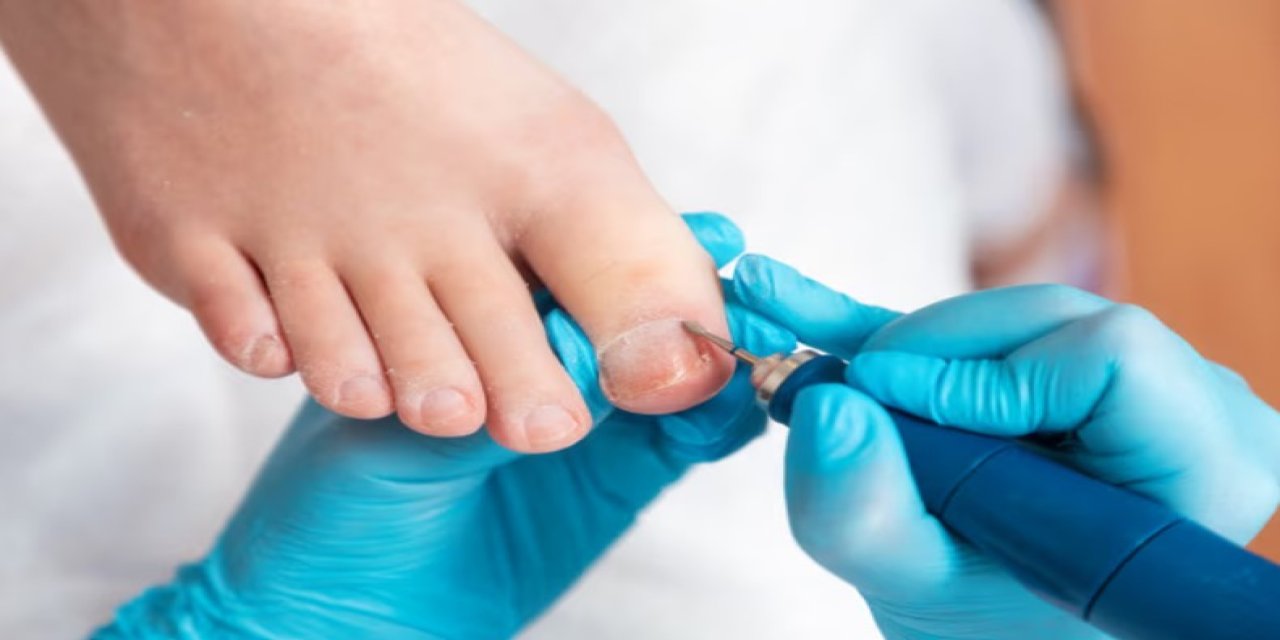 Mantar Hastalığı Nedir? Mantar Hastalığı Nasıl Geçer?