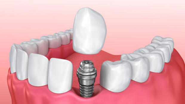 Dental implant tedavisi hakkında merak ettiğiniz her şey!